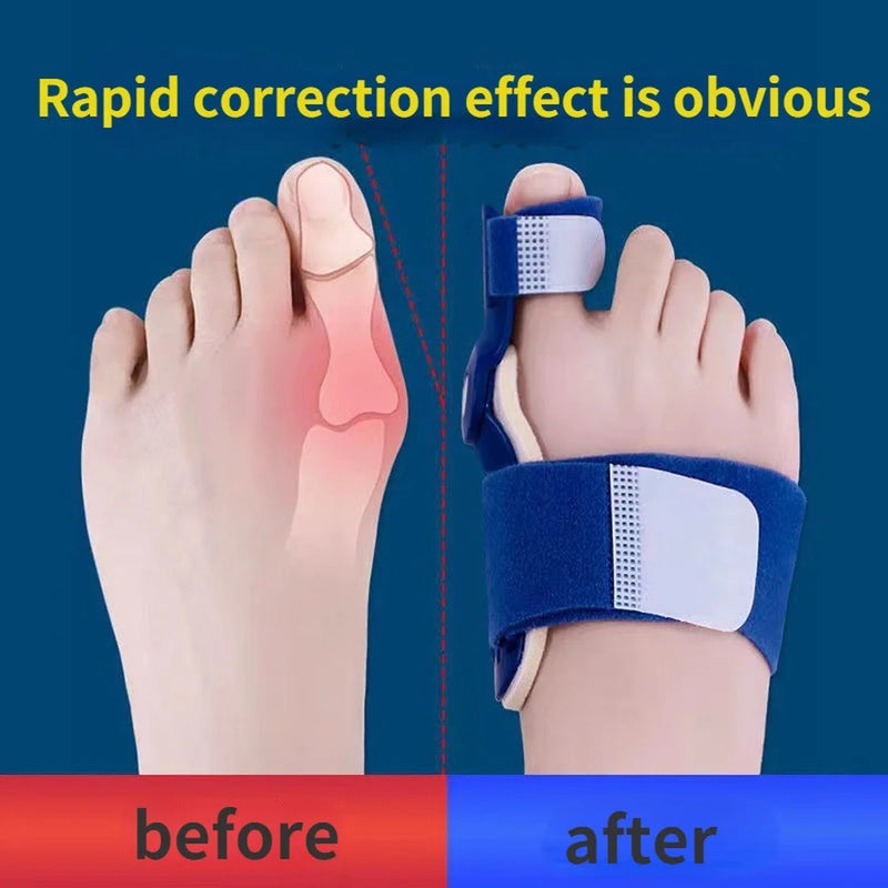 Orthopedic Bunion Splint Straightener and Corrector for Foot Pain Relief - Martsgaia